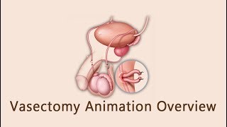 Vasectomy Animation Overview [upl. by Bald]