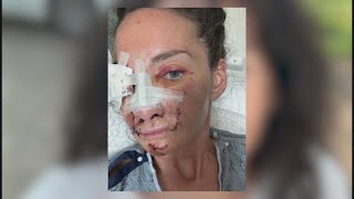 Months after freak accident metro woman shares life changing story [upl. by Eugatnom180]