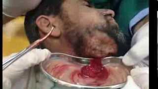 Hilton method for abscess Incision amp Drainage Subcutaneous تفجير خراج مسافة شدقية سني المنشأ [upl. by Kory]