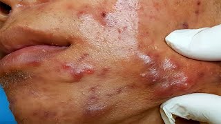 🤮puntos negro en la nariz extracción🔞🤢Black head [upl. by Auvil]