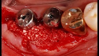 Transmucosal GBR using collagenated bone graft material  Dr Han Seung Min [upl. by Blayne908]