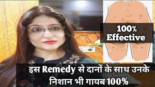 Butt HipsAcne की और Acne Marks हटाने की powerful Home Remedy  Get Rid of Butt Acne Fast  jaya [upl. by Areis115]