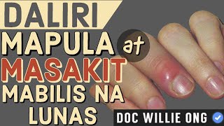 Daliri Mapula at Masakit Mabilis na Lunas  by Doc Willie Ong 1047 [upl. by Yttig]