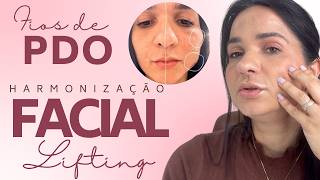 Fios de Sustentação PDO Lifting Facial [upl. by Kaile]