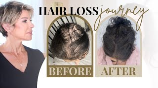 Hair Loss in Women Dr Approved Treatments Shampoos amp Thin Hair Hairstyles Tips  Dominique Sachse [upl. by Refinnej]