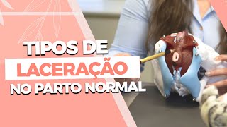 Tipos de LACERAÇÃO no parto normal [upl. by Imotih]