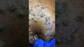 Removing large blackheads and pimples from face new 2021 23 [upl. by Buschi]