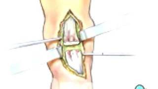 Malpractice Medical Achilles Tendon Repair Surgery 3 [upl. by Nnyloj]