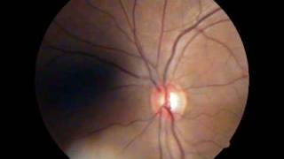 Optic Disc  Spontaneous Venous Pulsations [upl. by Killarney]