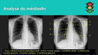 M1 Analyse de la radiographie thoracique médiastin [upl. by Aidroc]