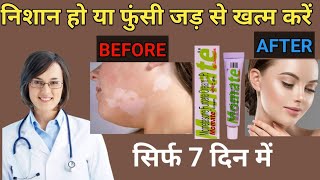 momate cream use in hindi mometasone cream [upl. by Tehcac840]