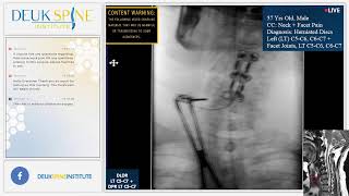 Deuk Plasma Rhizotomy DPR for Facet Joint Syndrome  C5C6 C6C7 [upl. by Yotal345]