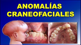 MALFORMACIONES CRANEOFACIALES O ANOMALIAS CONGENITAS DE DESARROLLO FACIAL [upl. by Anaerdna]