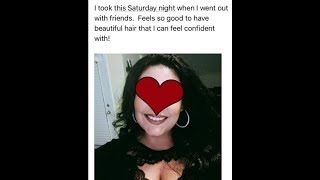 Trichotillomania Hair Regrowth Testimony [upl. by Rabah323]