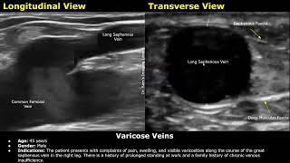 Varicose Veins Doppler Ultrasound Report Example  Lower Limb Venous Insufficiency Sonography USG [upl. by Ennej]