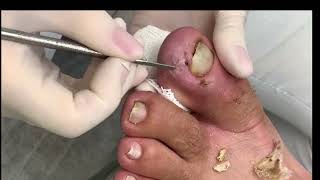 Unha encravada  ingrown toenail nails [upl. by Enilraep341]