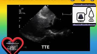 Total Anomalous Pulmonary Venous Return [upl. by Thorr883]