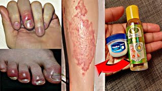 ठंड में खुजली व हाथ पैरों की उंगलियों की सूजन को करे जड़ से खत्म Feet and hand Swelling In Winter [upl. by Chicky]