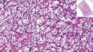 Clear Cell Renal Cell Carcinoma  Histopathology [upl. by Esilegna127]