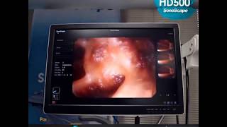 Videoendoscopio HD500 Sonoscape [upl. by Ainitsirc]