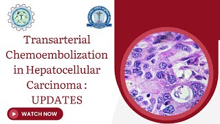 Transarterial Chemoembolization in Hepatocellular Carcinoma [upl. by Nylirehs]