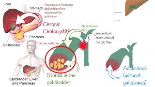 Cholecystitis Signs and symptoms Chronic and acute Cholecystitis biliary colic [upl. by Lole]