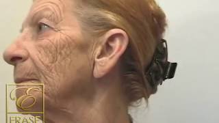 anti aging cream  worlds best fast acting anti aging wrinkle cream demonstration [upl. by Rozanna]