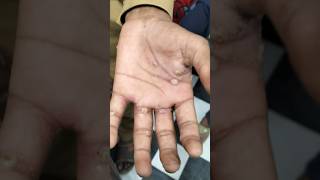 Example of scabies  Sarcoptes scabiei scabies scabiestreatment scabiespadakucing medical viral [upl. by Anniroc325]