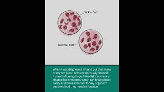 Sickle Cell Disease Hemoglobin S Disease [upl. by Gweneth]