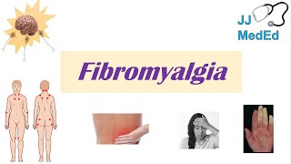 Fibromyalgia  Symptoms Associated Conditions Diagnosis Treatment [upl. by Imhskal686]