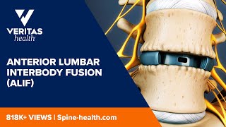 Anterior Lumbar Interbody Fusion ALIF [upl. by Albertina]