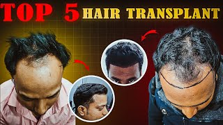 Hair Transplant Top 5 ResultsDensity Hair Transplant RanchiHair Transplant in jharkhand [upl. by Sayles45]