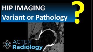 How to identify supraacetabular fossa and superior acetabular roof notch on Hip MRI [upl. by Canning]