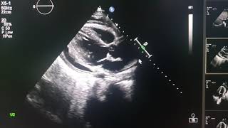 effuso constrictive pericarditis echocardiography [upl. by Carney]