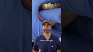 Invisalign Pain Will it hurt and is it better or worse than braces [upl. by Aiyram]