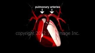 Saddle embolus pulmonary embolism video  Animation by Cal Shipley MD [upl. by Branch553]