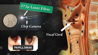 Laser Treatment of Laryngeal Papillomas RRP [upl. by Selyn708]