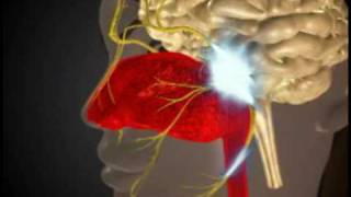 Tolosa Hunt Syndrome [upl. by Monahan]