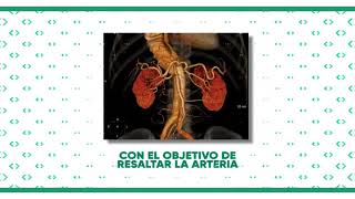 Angiotomografía de aorta [upl. by Dav]