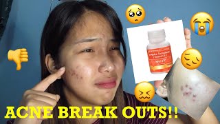 MYRA E REVIEW Philippines 2 bottles down  ACNE BREAKOUTSXhiia Cardinio [upl. by Gudrin864]