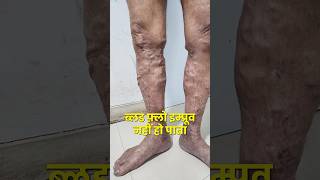 Is Varicose veins and deep vein thrombosis related  varicosevein dvt youtubeshorts shortvideo [upl. by Niall]