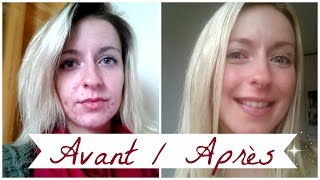 ACNE ❀ Roacutane mois après mois [upl. by Alfonzo648]