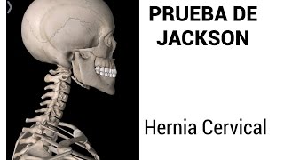 PRUEBA PARA DETECTAR UNA HERNIA CERVICAL [upl. by Dorca]