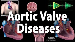 Aortic Valve Disease Animation [upl. by Aitram]