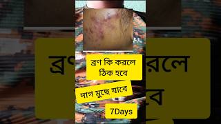 ব্রণ আছে দাগ মোছার সহজ উপায় sscgdmedical agniveer acene pimples skincare youtubeshorts [upl. by Ayaj]