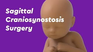 Sagittal Craniosynostosis Surgery [upl. by Aniuqal]