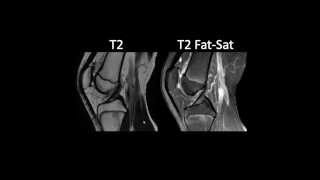 RM musculoesquelética T2 Fat Sat e STIR [upl. by Stets65]