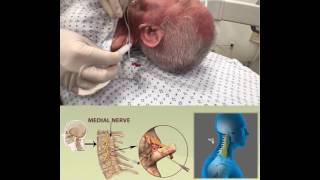 CERVICAL RADIOFREQUENCY ABLATION [upl. by Mellitz]