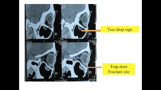 Blow Out Fracture of Orbit [upl. by Umeh]