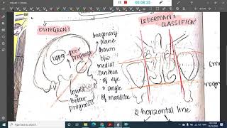 paranasal sinus tumors  ENT [upl. by Ahsain157]